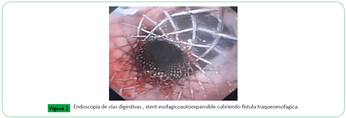 archivosdemedicina-traqueesofagica