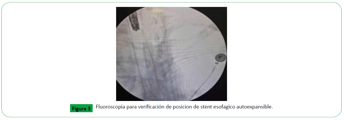 archivosdemedicina-traqueesofagica